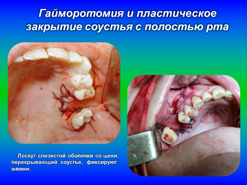 Гайморотомия и пластическое закрытие соустья с полостью рта      Лоскут